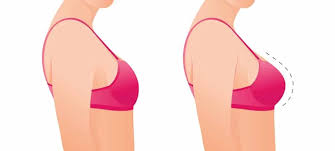 Hành trình hồi phục sau nâng ngực