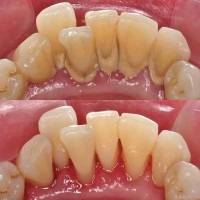 Giá lấy cao răng – đừng vì tiết kiệm nhỏ mà đánh đổi sức khỏe răng miệng