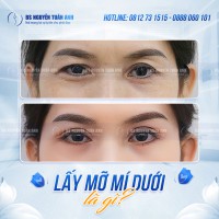 lấy mỡ mí dưới có làm vùng mắt sáng hơn không?